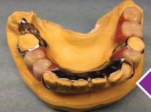 partial denture repair